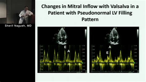 echocardiographic evaluation Lv filling